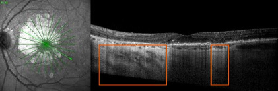 Baseline OCT scan with BCVA of 20/25, showing choroidal hypertransmission defect